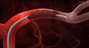 Neurovascular Device Market