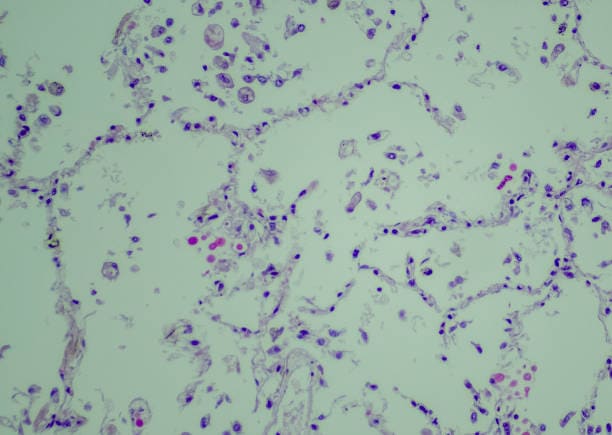 U.S Cryptococcosis Market Growth: Innovation-Driven Strategy Insights