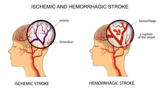 Chaina Ischemic Stroke Therapeutics Market Report: Comprehensive Overview of Developments
