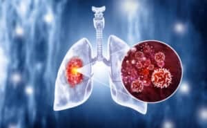 Lung Cancer Diagnostic Test