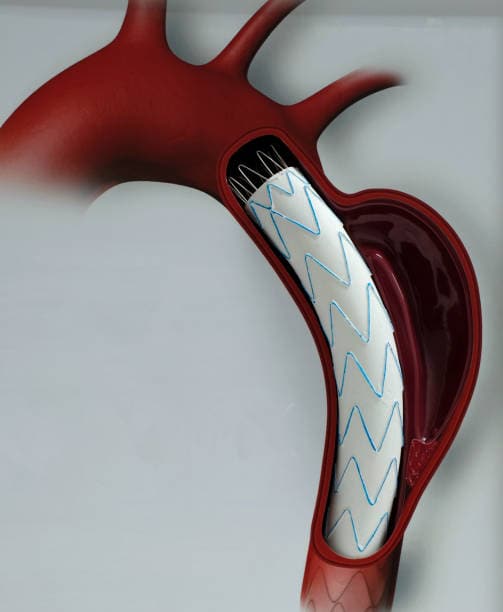 U.S. Thoracic Stent Graft Market Growth Forecast: Market Drivers, Challenges, and Trends (2025-2035)