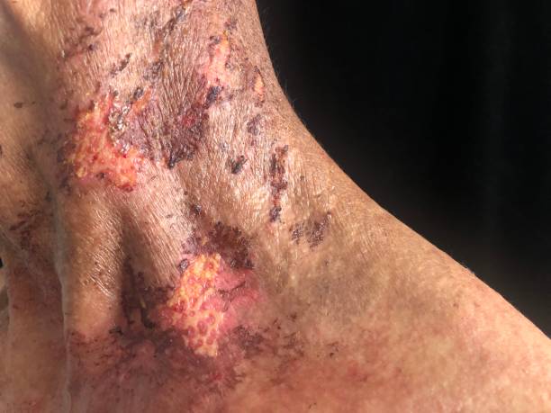 Japan Chemotherapy Induced Acral Erythema (Hand Foot syndrome) Treatment Market Outlook 2025: Forecasting Growth in a Time of Economic and Policy Shifts