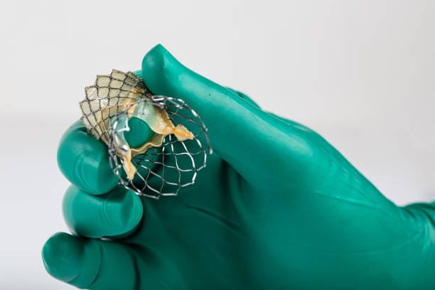 Japan Embolic Protection Devices Market Reset: Analyzing Economic Stressors and Trade Policy Shocks