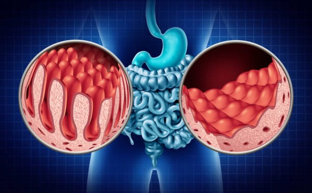 Europe Inflammatory Bowel Disease Therapeutics Market Economic Forecast: Steering Through Trade-Offs in a Volatile Global Environment