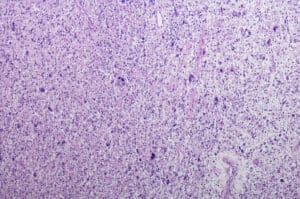 Malignant Peripheral Nerve Sheath Tumour