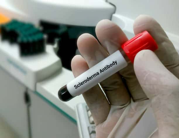North America Scleroderma Diagnostics and Therapeutics Market Strategies: Competitive Insights for Expansion