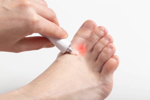 Europe Athlete’s Foot Drugs Market Study: Comprehensive Segmentation and Forecast