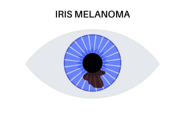 china Eye Melanoma Market in Flux: Recession Signals, Tariff Pressures & Strategic Forecasts