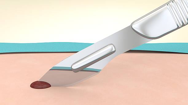 Japan Skin Graft Blades Market Spotlight: Size, Share, and Growth Trends Explored through 2035