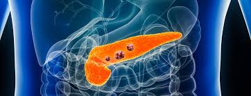 The Global Pancreatic Cancer Market is projected to reach USD 5.01 billion by 2030