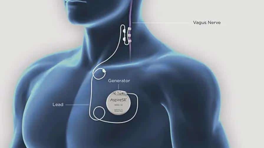 The Implantable VNS Devices Market is projected to reach a market size of $ 793.70 Million by 2030