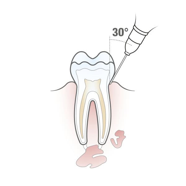 Carpule intraligamental - Imagen 2