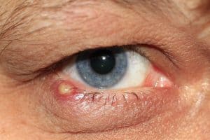 Key point: Chronic Inflammation: The Hidden Culprit