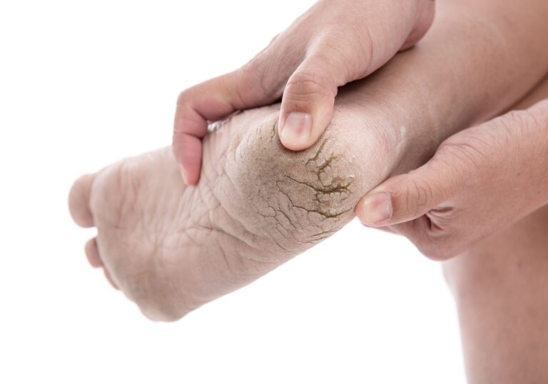 Kitchen remedies for cracked heels