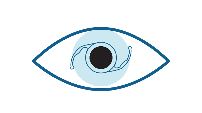 IOL Clear lens Exchange Refractive lens Exchange