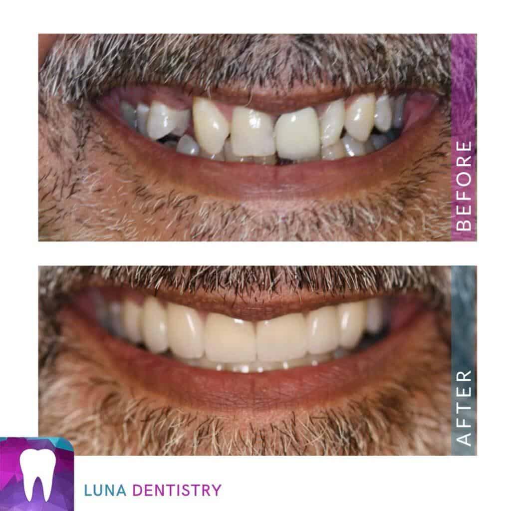 Porcelain Crown Case Study