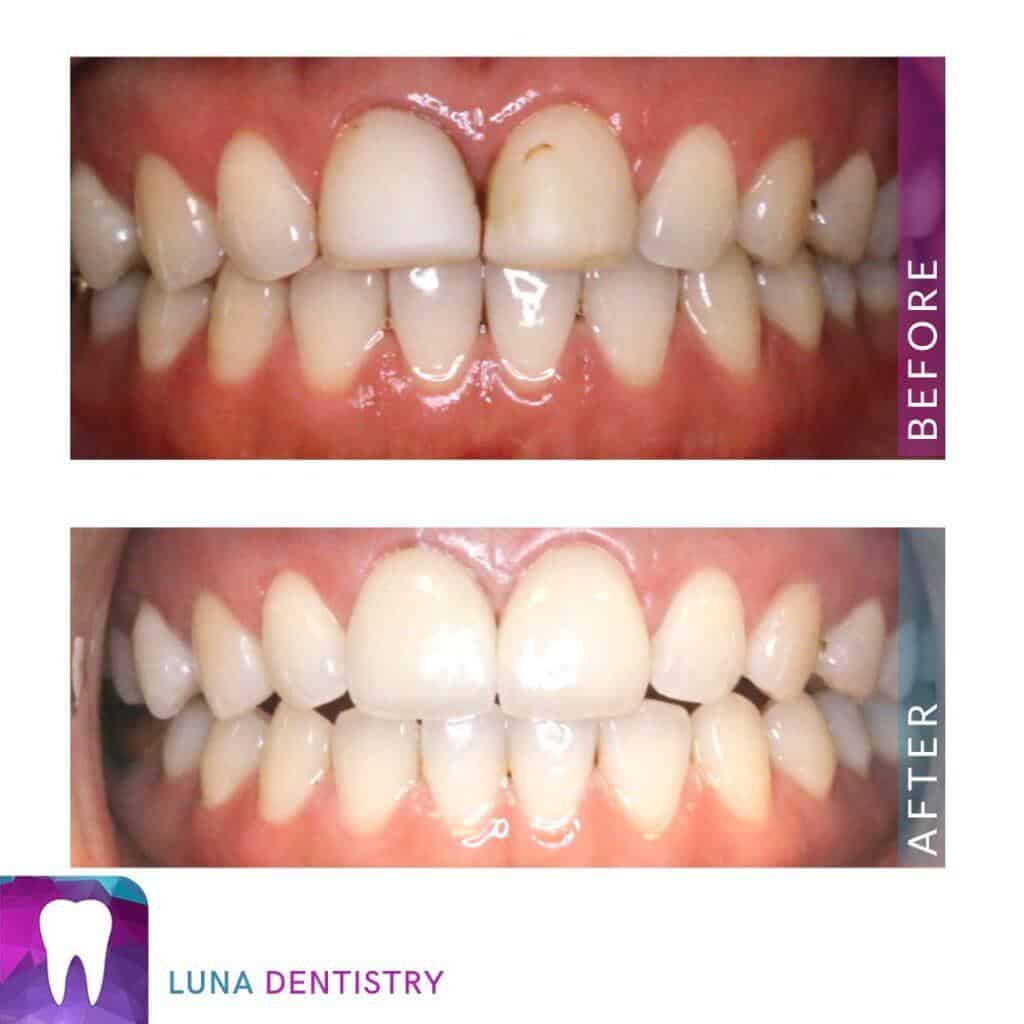 Veneers Case Study