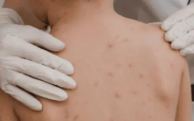 June 2024 – Public Health confirms 6 chickenpox cases