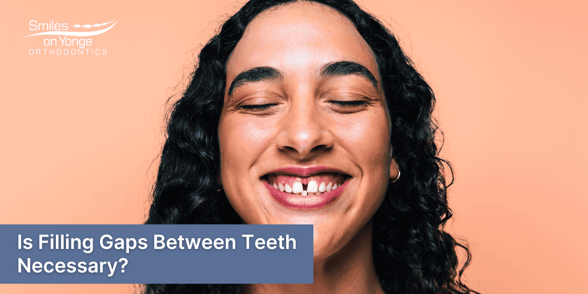 Is Filling Gaps Between Teeth Necessary?