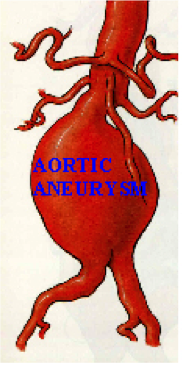 aorta What is an Aneurysm?