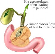 Biliary and Pancreatic Treatments