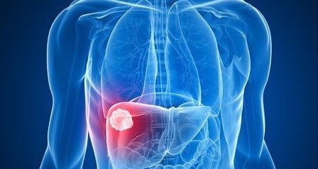Liver Tumors