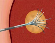 Minimally Invasive Treatments