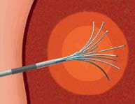 Minimally Invasive Treatments