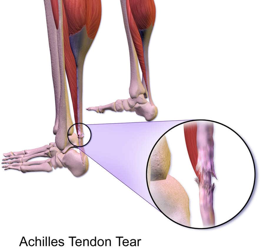 Achilles tendon 
