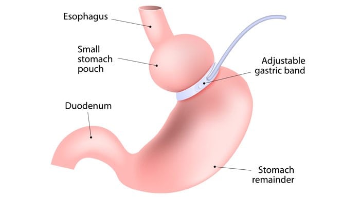 Programs and Services (bariatric weight loss surgery)

