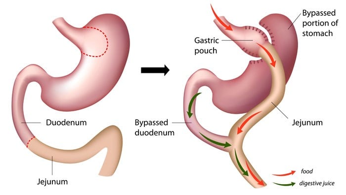 Programs and Services (bariatric weight loss surgery)

