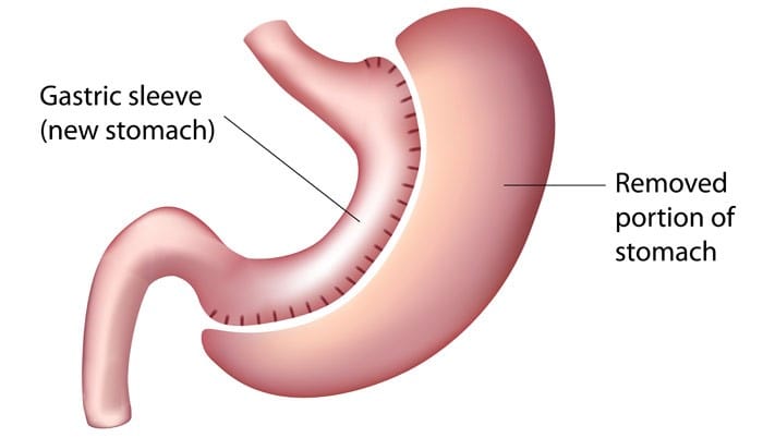 Programs and Services (bariatric weight loss surgery)

