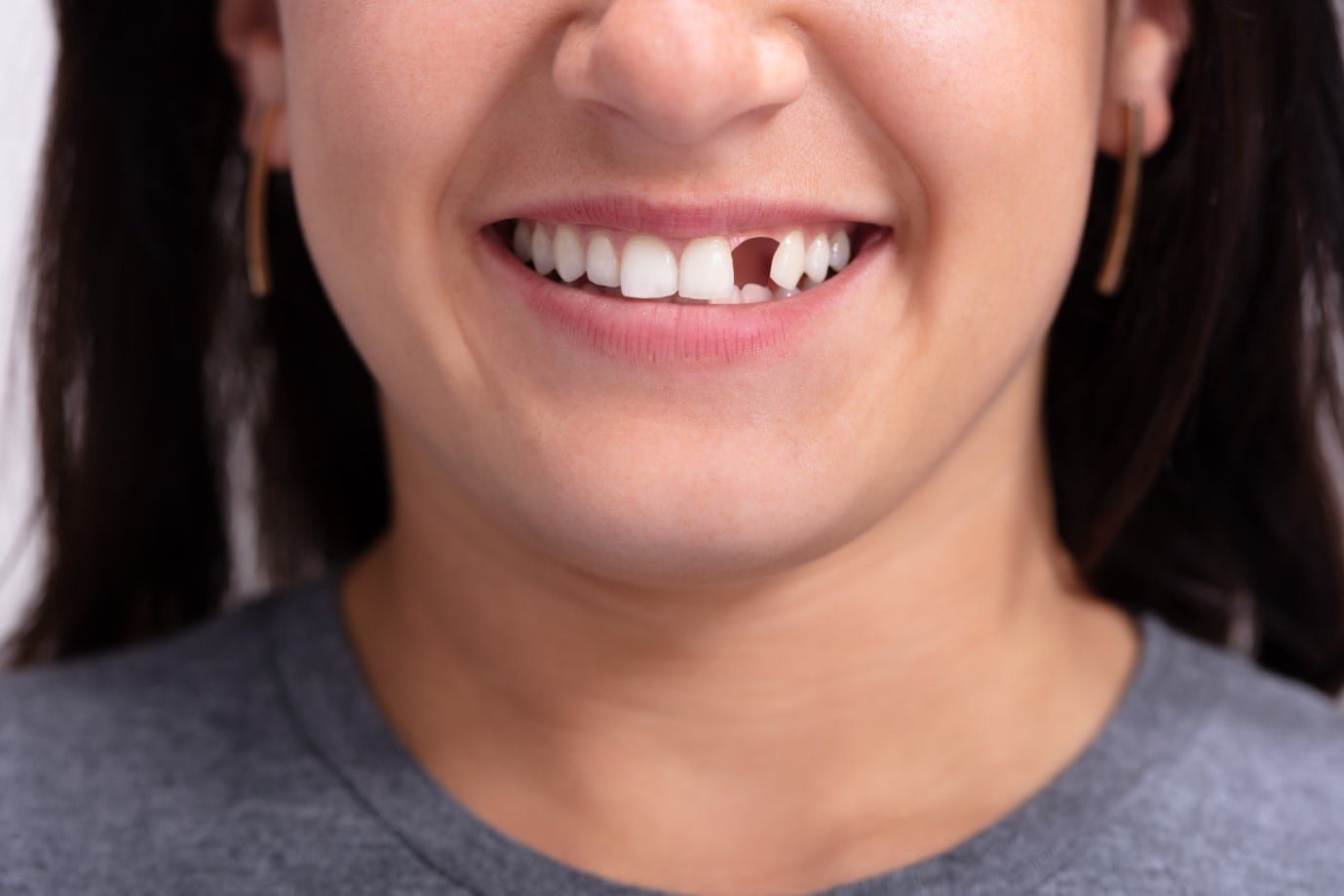 7 Ways To Replace A Missing Front Tooth