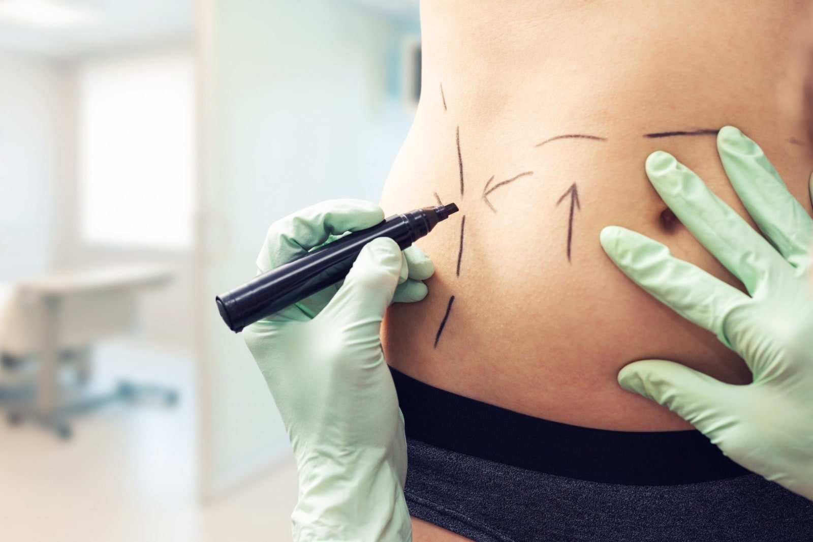 Tummy Tuck Before And After