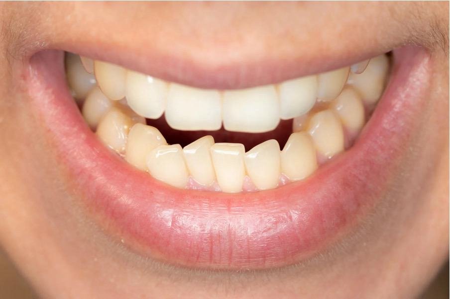 Smile Safely: The Importance Of Addressing Dental Crowding For Oral Health