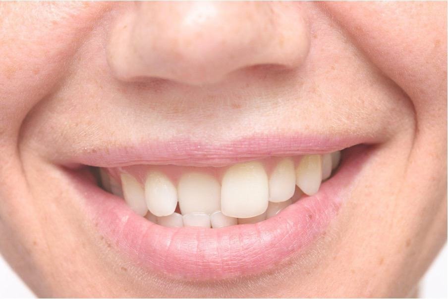 The Difference Between Overbite Vs Underbite: Causes And Treatment Options