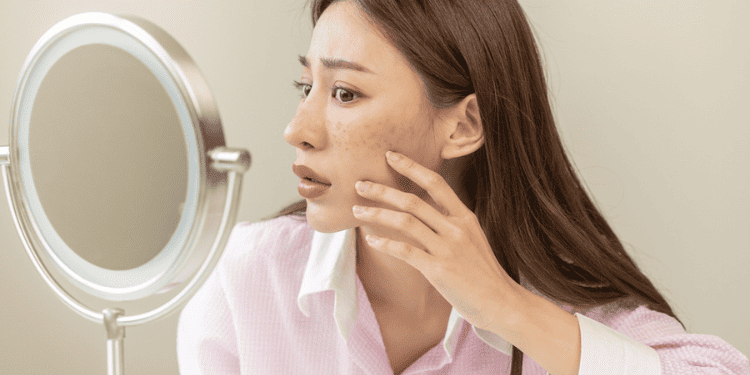 Face Pigmentation Treatment