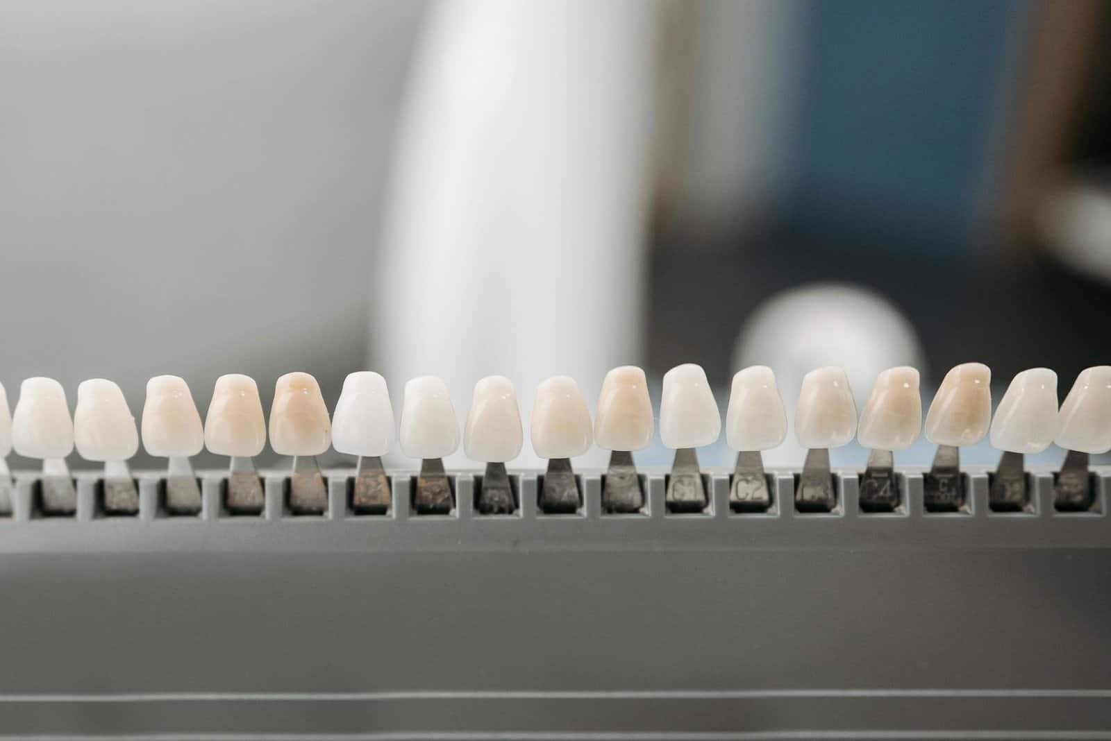 Composite Veneers