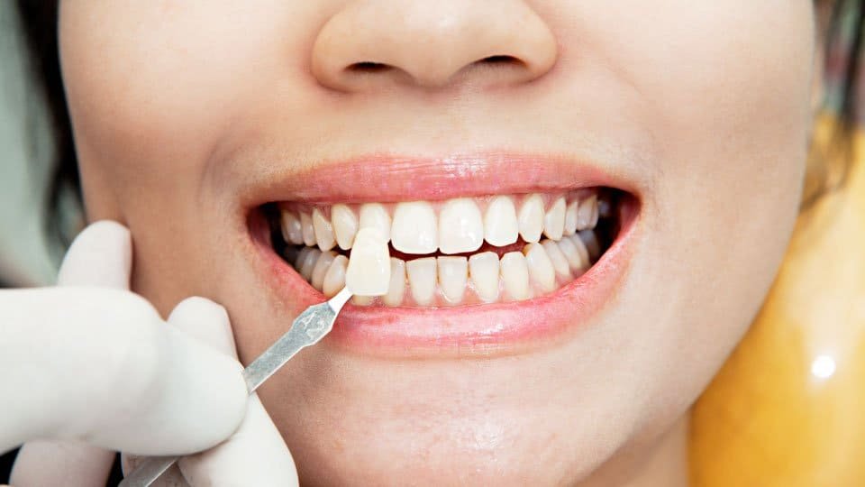 How Long Do Veneers Last