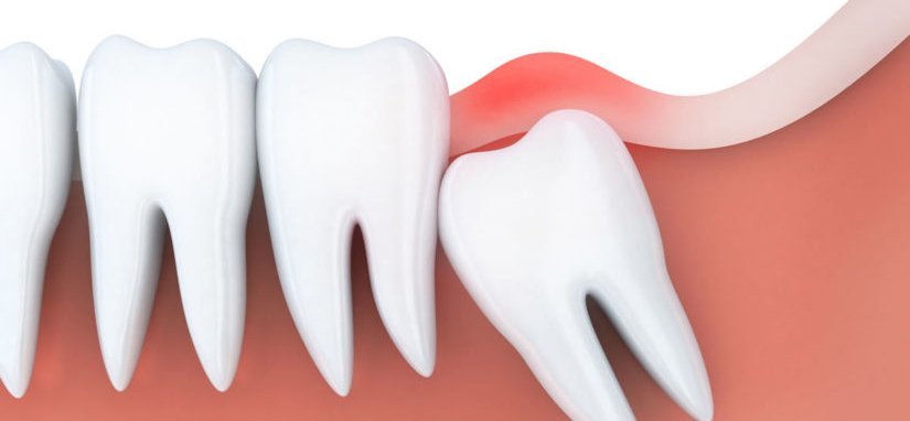 Wisdom Teeth Removal Aftercare
