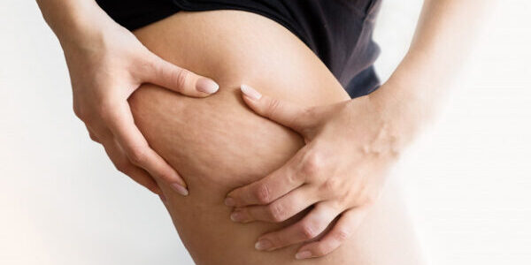 girl-shows-holding-pushing-skin-legs-cellulite-orange-peel_69064-1144