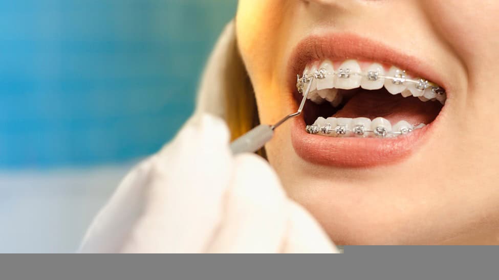 braces in Raleigh, NC