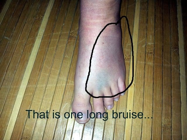 Recovering sprained foot