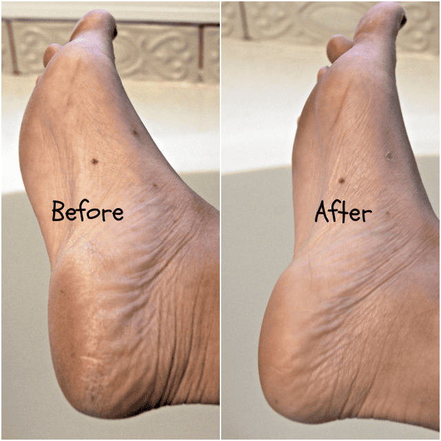 Amope before and after