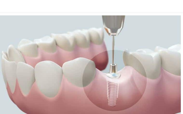 Biological Implants Market Projected to Reach USD 267.97 Billion by 2030, Growing at a CAGR of 9.6%