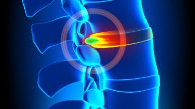 herniated-disc-featured