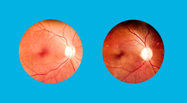 China Diabetic Eye Disease Equipment Market Growth Unveiled: Strategic Future Insights