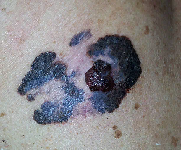 China Uveal Melanoma Market Outlook: Strategic Growth & Industry Insights