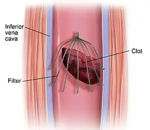 Inferior Vena Cava (IVC) Filter Market Setting New Growth Cycle; Get 2025 Edition Now”
