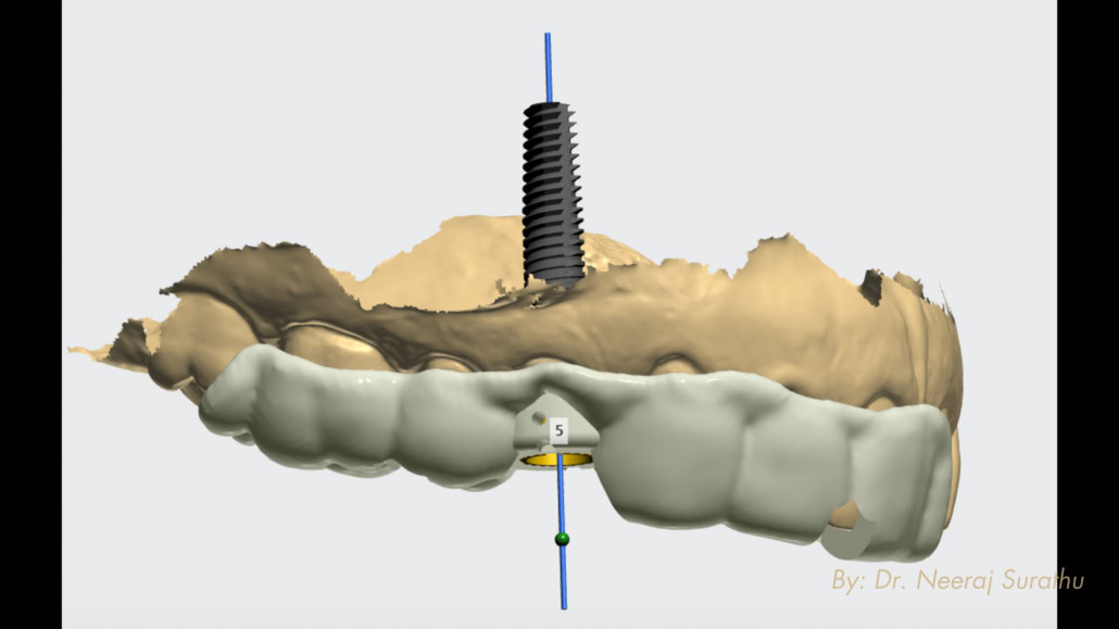 Surgical guide shown on the digital implant planning software